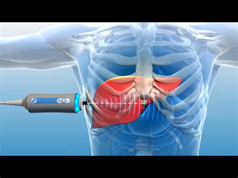 fibroscan locations.
